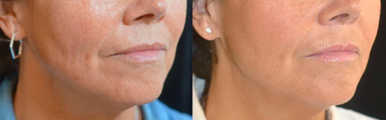 Juläine before and after, continued softening of the nasolabial folds and lower face two months after the second session (official Juläine clinical result, clinic Entouch, injected by Annika Harlén)