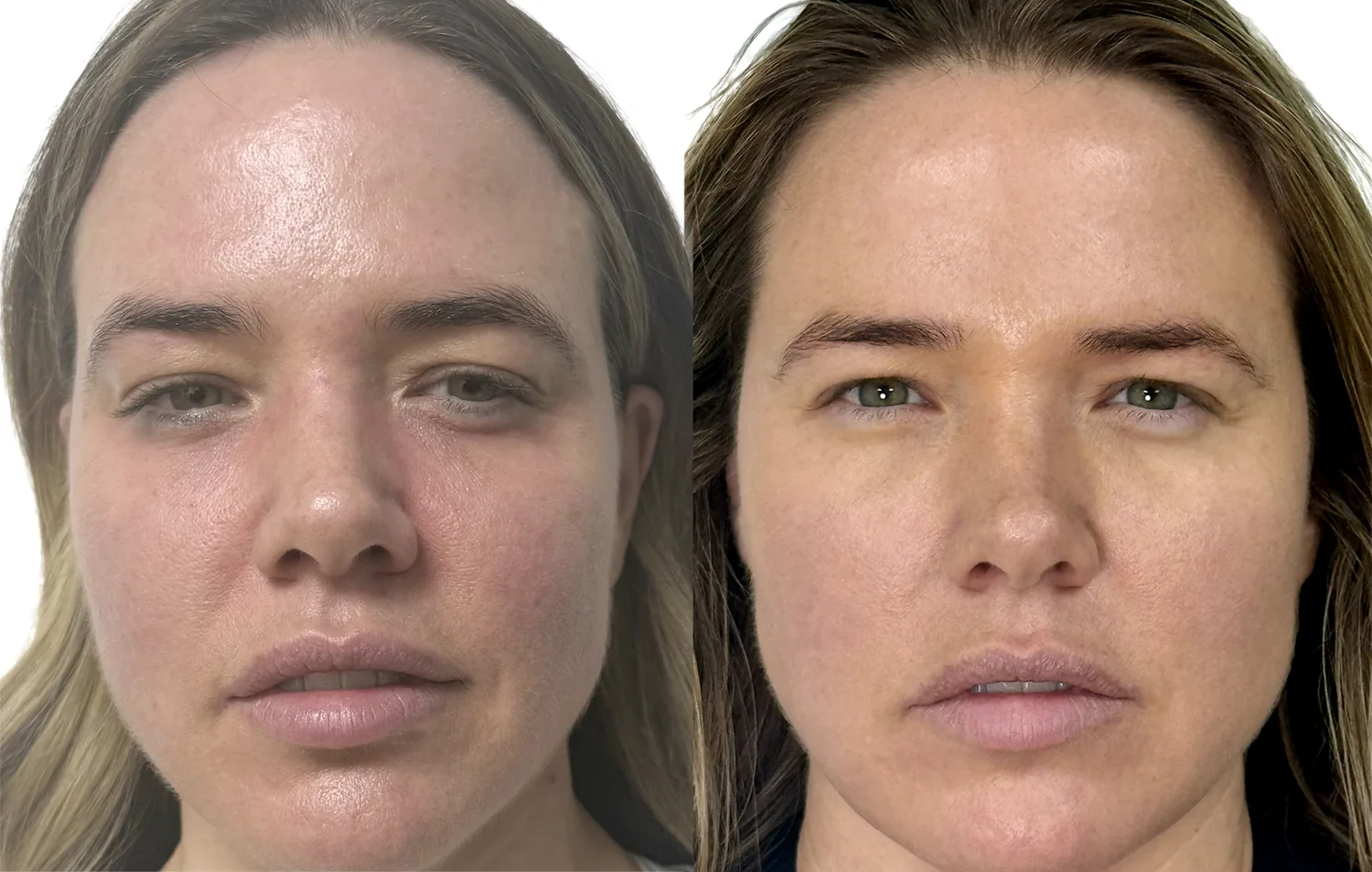 Sunekos before and after London, the same patient before and after their first Sunekos facial session, showing more hydrated, more even skin