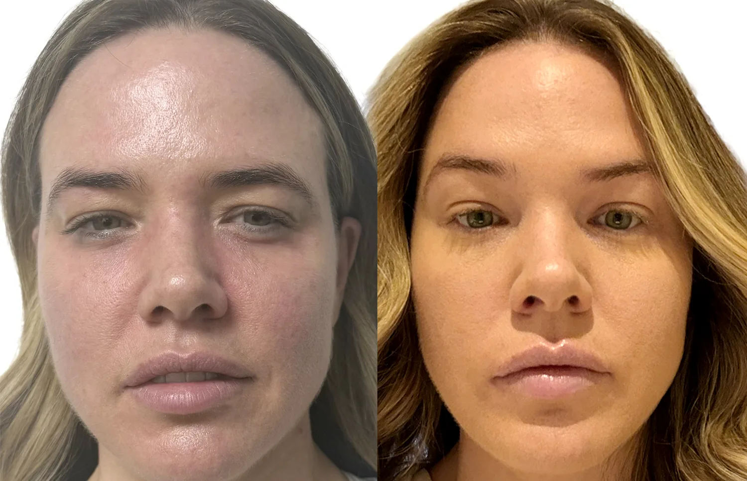 Sunekos before and after London, the same patient after a further Sunekos Performa session, with reduced under-eye vascular shadowing and improved skin texture