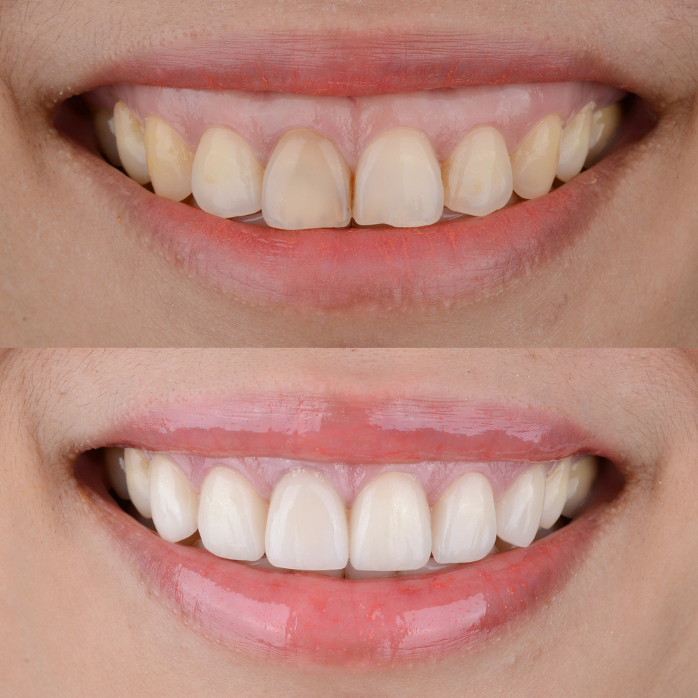 gummy smile botox before and after